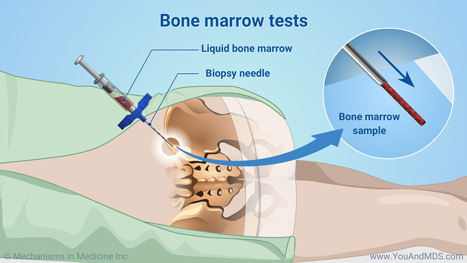 Bone marrow tests