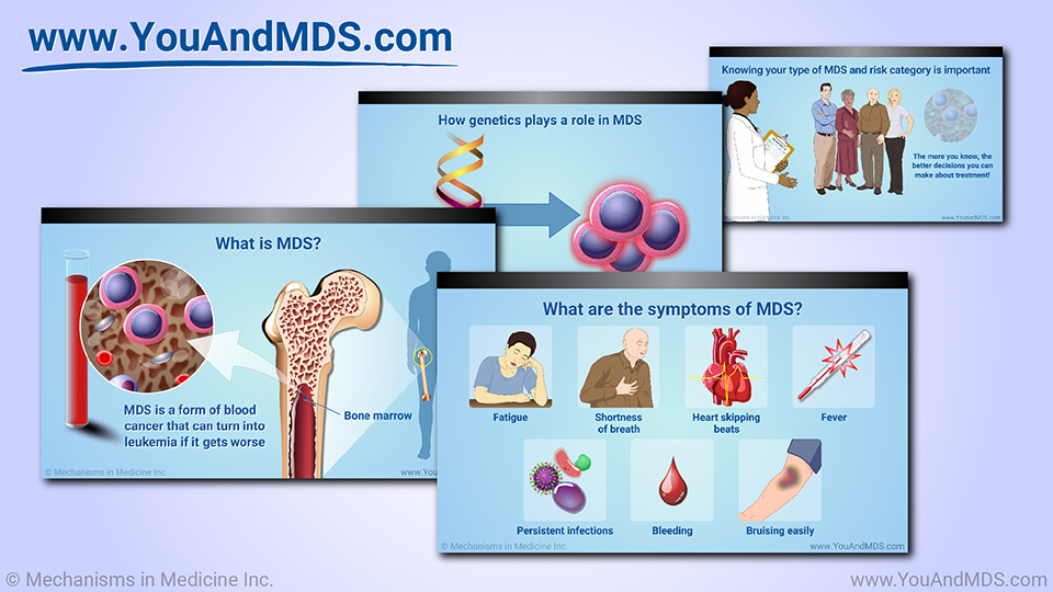 Slide Show - Understanding Myelodysplastic Syndromes