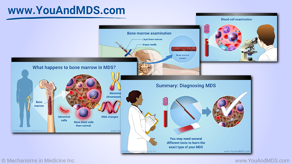 Diagnosis of MDS