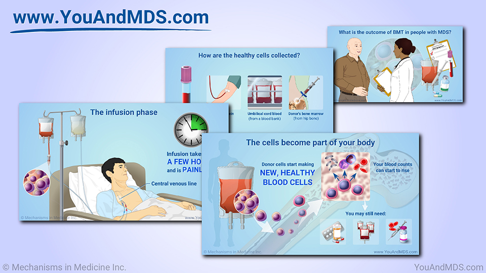 Slide Show - Blood and Marrow Transplantation in MDS
