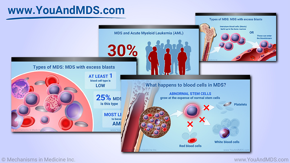 Slide Show - Understanding MDS-related Anemia