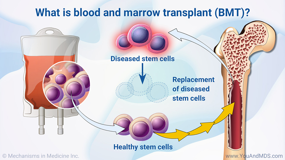 What is a blood and marrow transplant (BMT)?