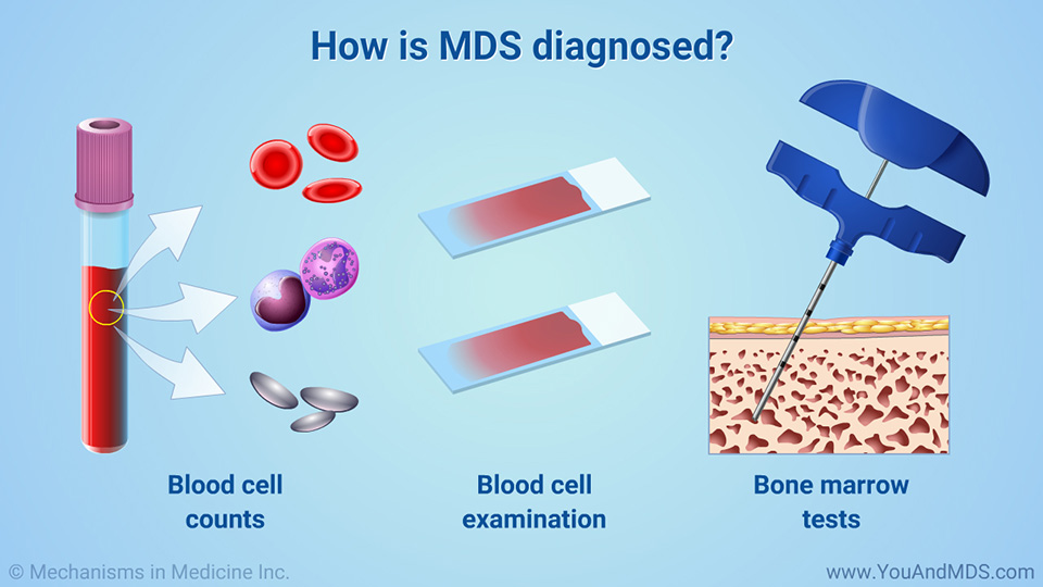 How is MDS diagnosed?