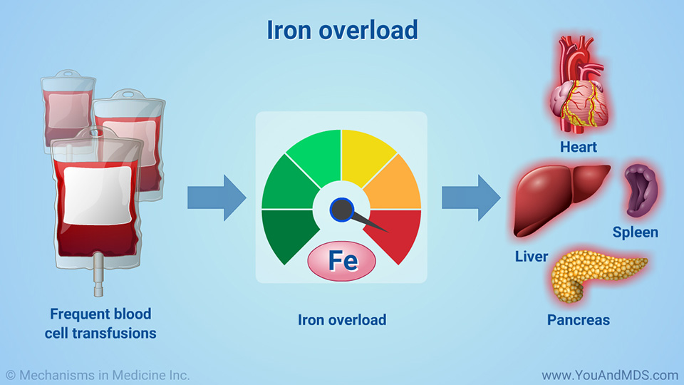 Iron overload