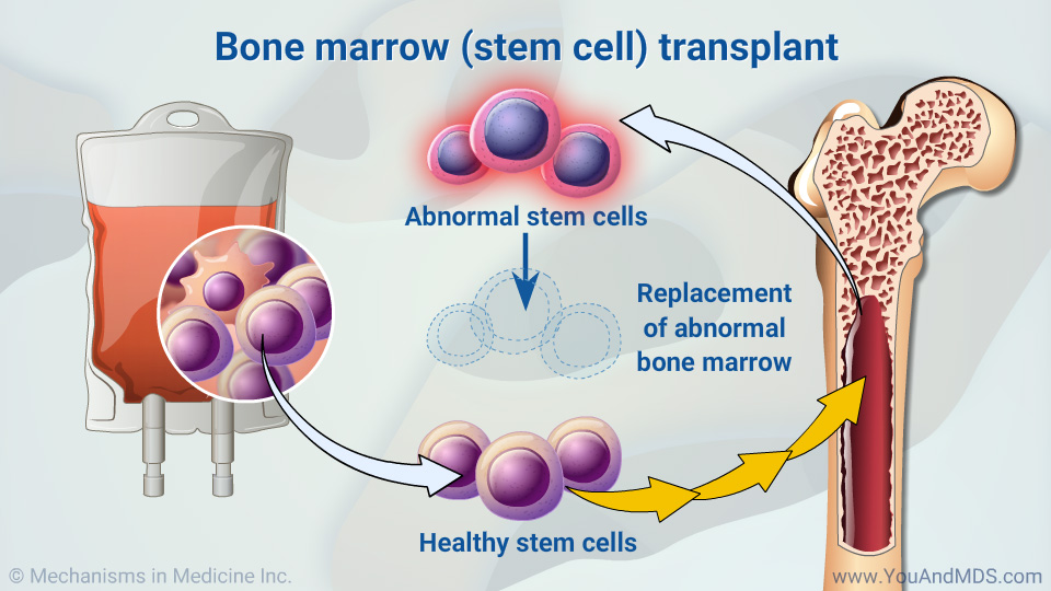 Bone marrow (stem cell) transplant