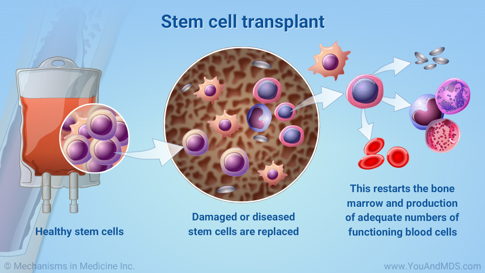 Stem cell transplant