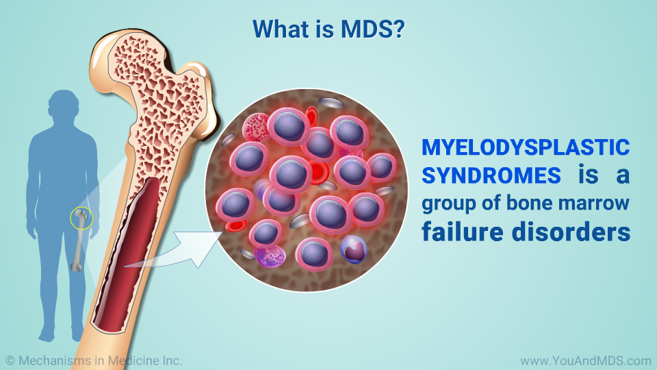 What is MDS?