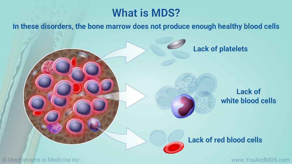 What is MDS?