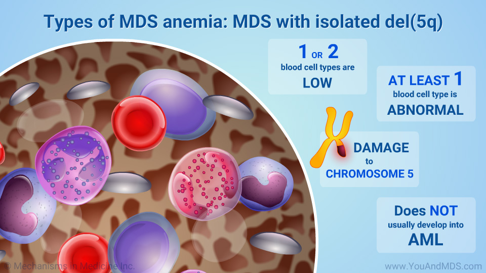 Types of MDS anemia: MDS with isolated del(5q)