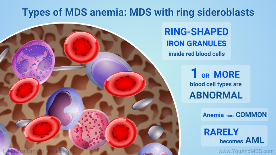 Types of MDS anemia: MDS with ring sideroblasts