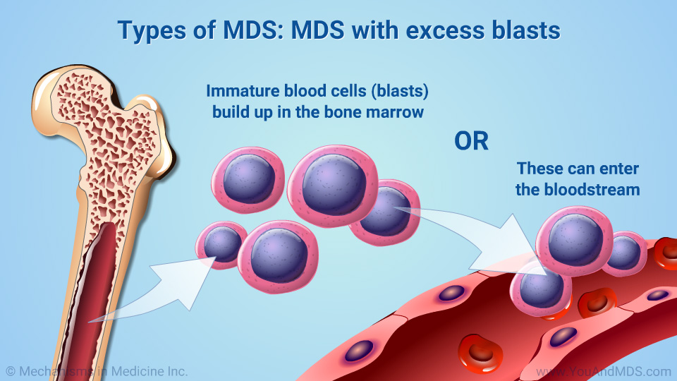 Types of MDS: MDS with excess blasts 