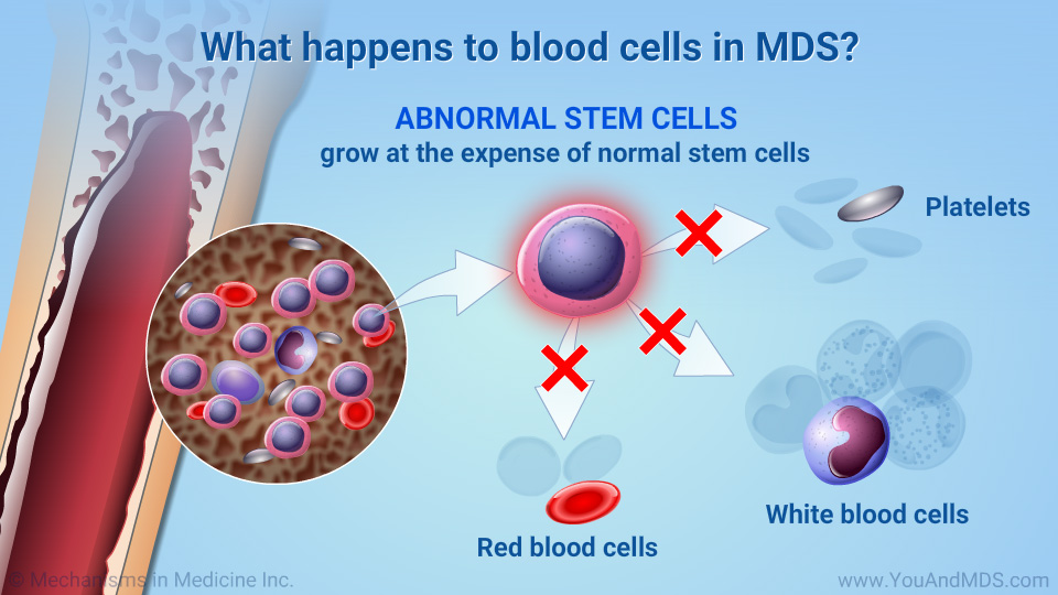 What happens to blood cells in MDS?