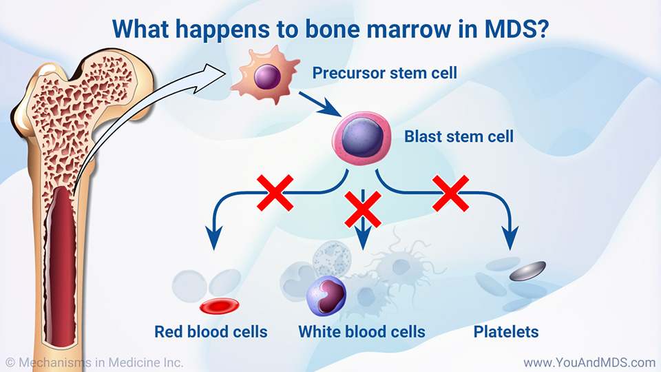 What happens to bone marrow in MDS?