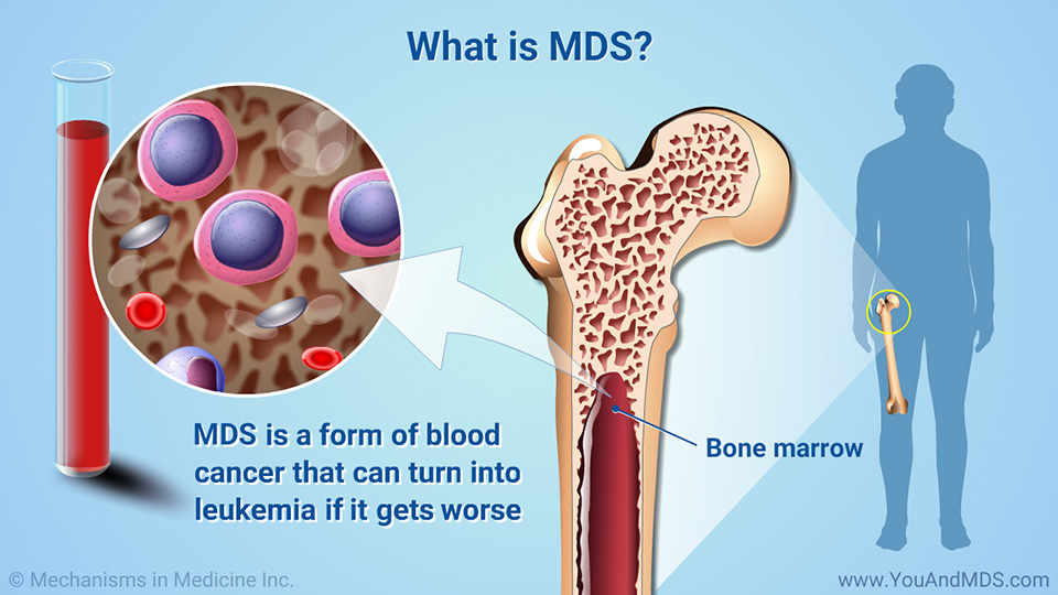 Slide Show Understanding Myelodysplastic Syndromes